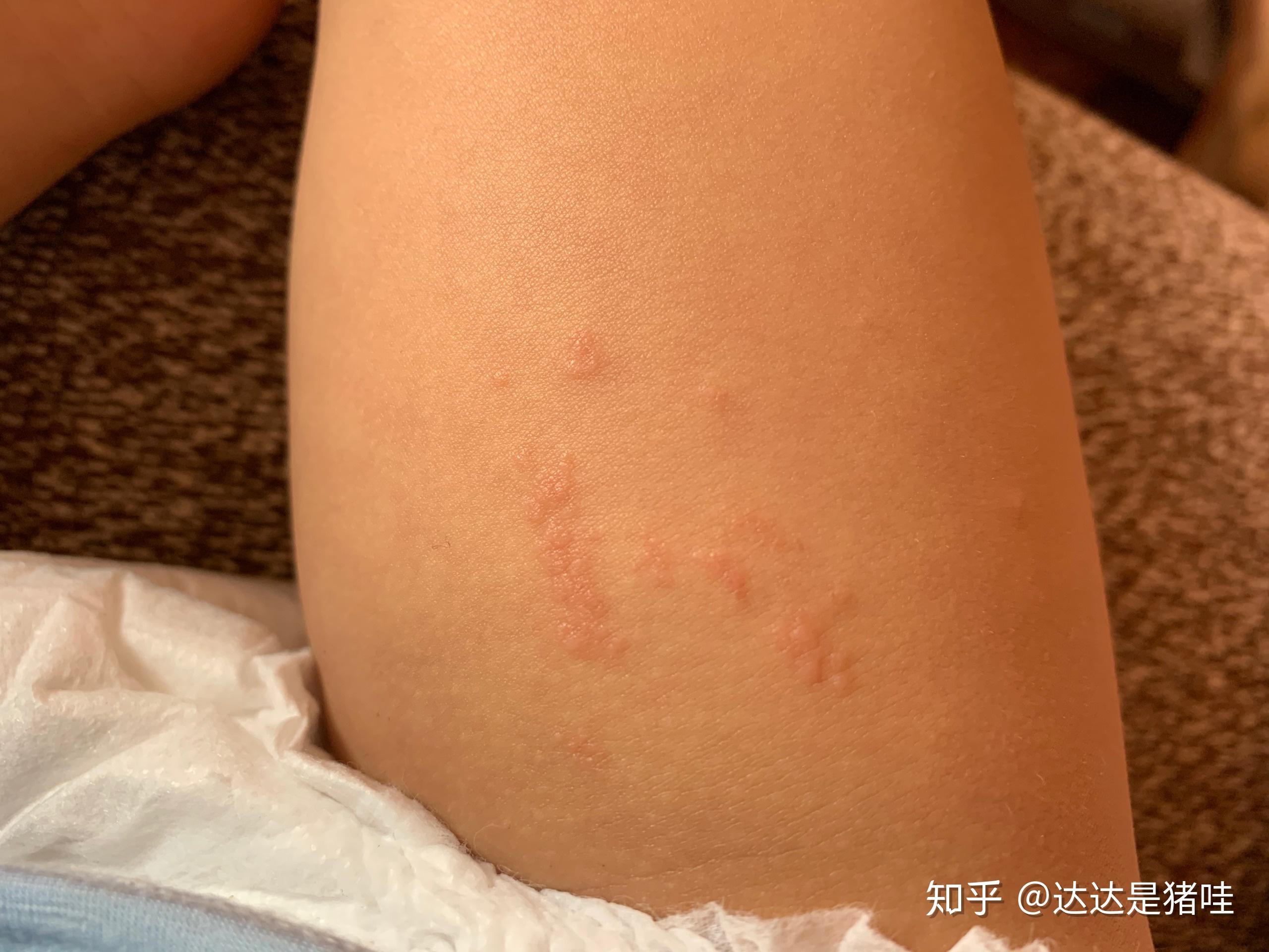 宝贝把腿张得大一点就不痛了小说宝贝腿部疼痛缓解之谜